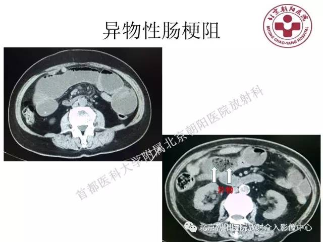【PPT】急腹症影像诊断思路