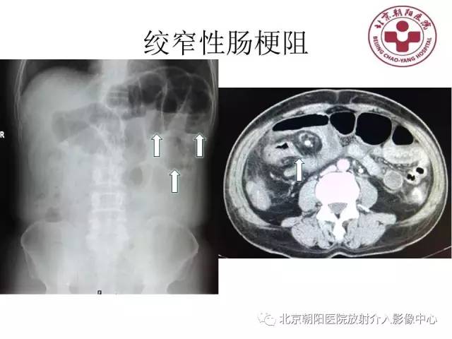 【PPT】急腹症影像诊断思路