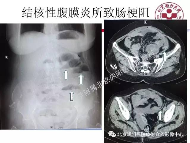 【PPT】急腹症影像诊断思路