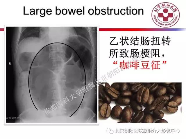 【PPT】急腹症影像诊断思路