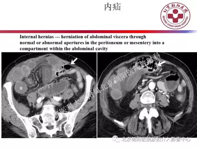 【PPT】急腹症影像诊断思路