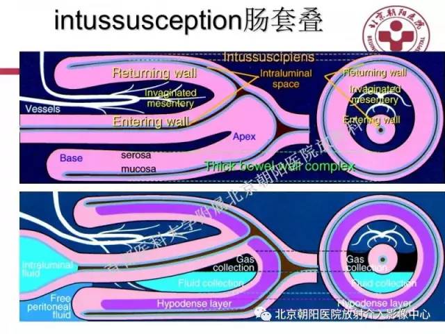【PPT】急腹症影像诊断思路