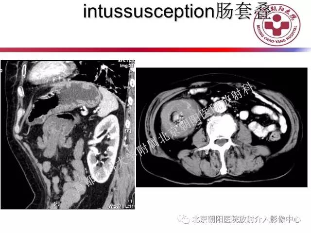【PPT】急腹症影像诊断思路