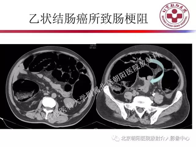 【PPT】急腹症影像诊断思路
