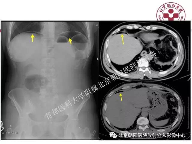 【PPT】急腹症影像诊断思路