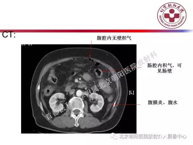 【PPT】急腹症影像诊断思路