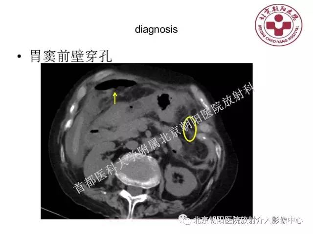 【PPT】急腹症影像诊断思路