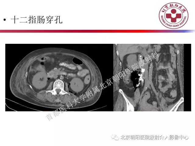 【PPT】急腹症影像诊断思路