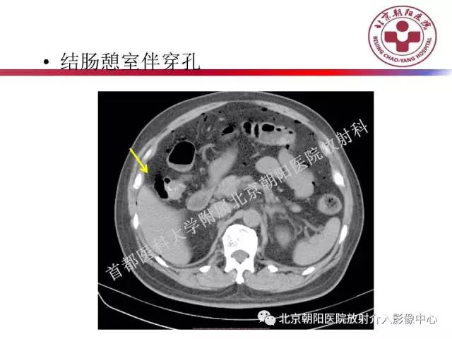 【PPT】急腹症影像诊断思路