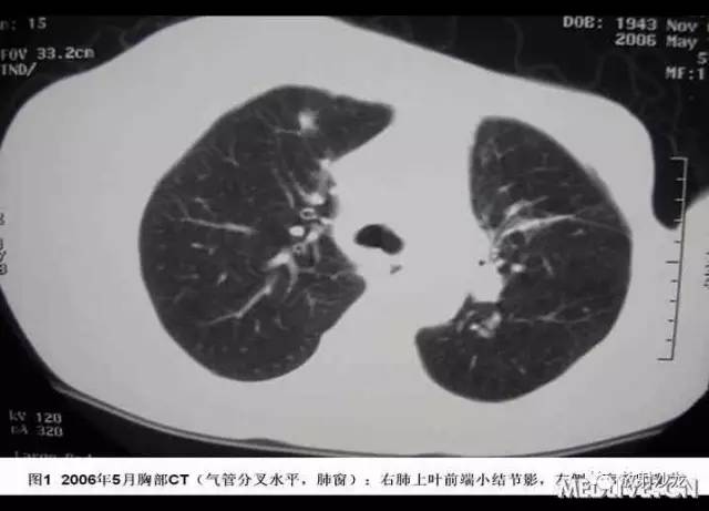 【病例】肺Castleman病1例 【病例】肺Castleman病1例