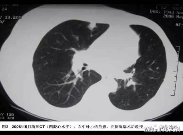 【病例】肺Castleman病1例 【病例】肺Castleman病1例
