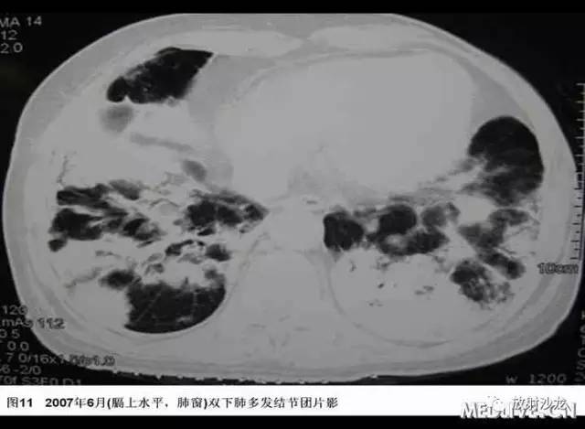 【病例】肺Castleman病1例 【病例】肺Castleman病1例