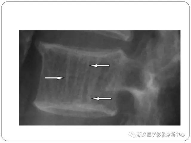【PPT】椎体血管瘤的影像表现和鉴别