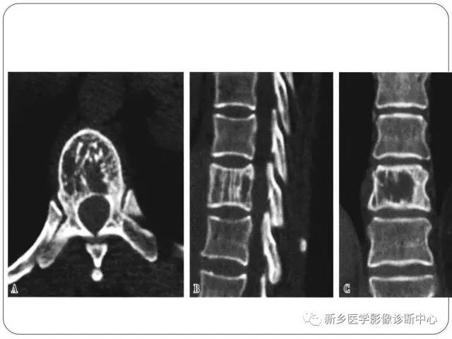 【PPT】椎体血管瘤的影像表现和鉴别