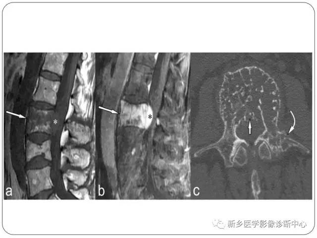 【PPT】椎体血管瘤的影像表现和鉴别
