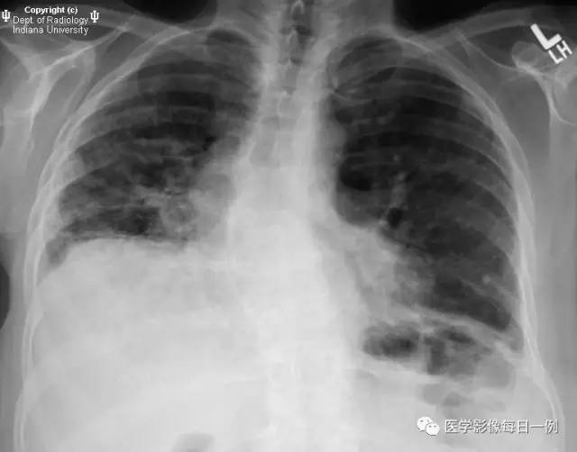 【病例】硬皮病1例CT影像表现 【病例】硬皮病1例CT影像表现