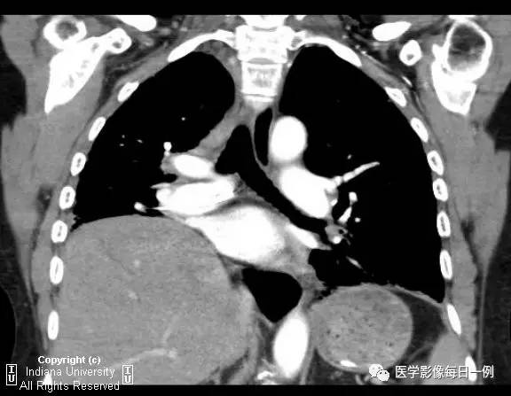【病例】硬皮病1例CT影像表现 【病例】硬皮病1例CT影像表现