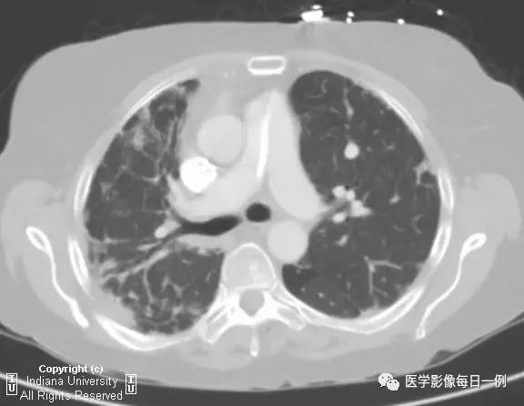 【病例】硬皮病1例CT影像表现 【病例】硬皮病1例CT影像表现