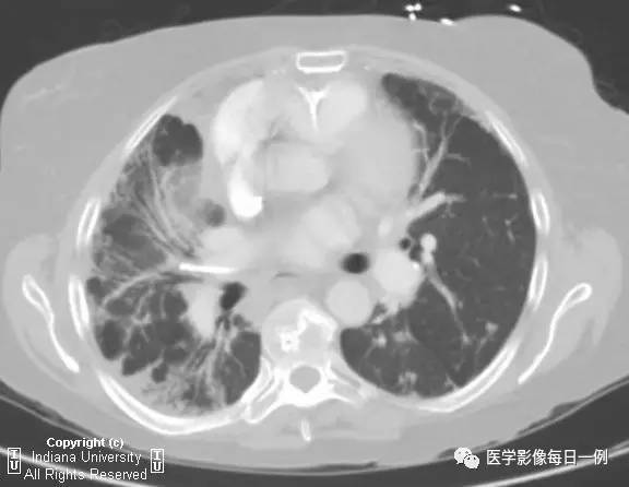 【病例】硬皮病1例CT影像表现 【病例】硬皮病1例CT影像表现