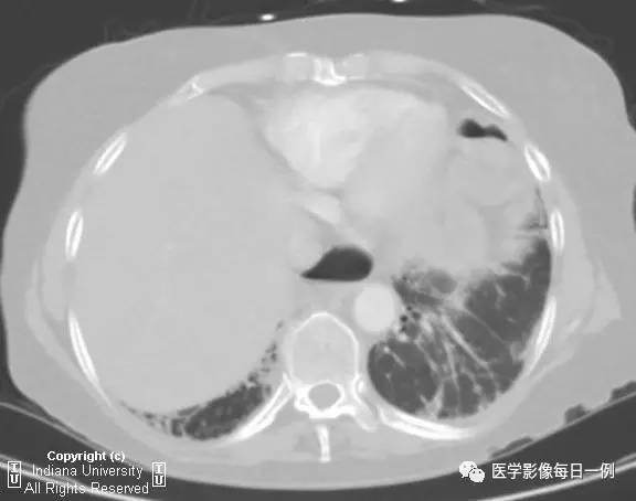 【病例】硬皮病1例CT影像表现