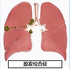 那些你知道和不知道的结核 那些你知道和不知道的结核