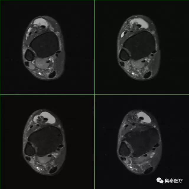 【病例】腱鞘囊肿1例MR影像表现