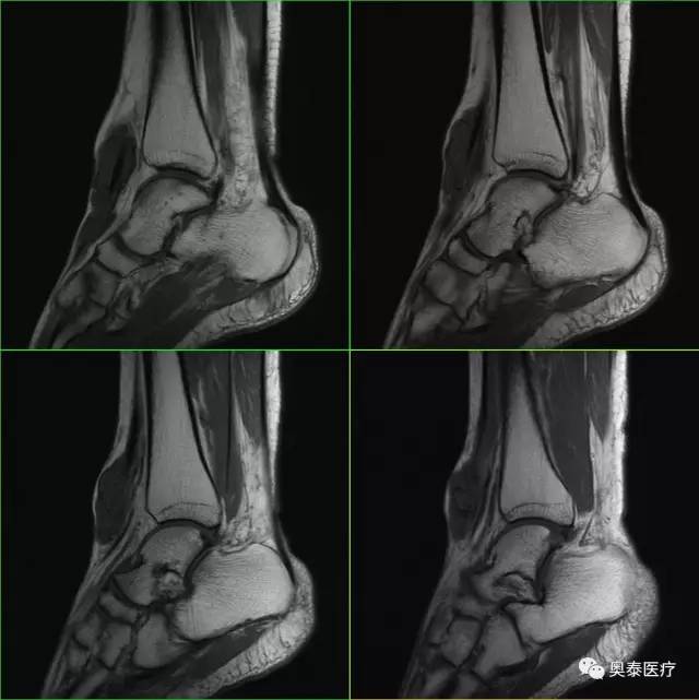 【病例】腱鞘囊肿1例MR影像表现 【病例】腱鞘囊肿1例MR影像表现