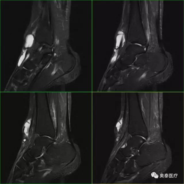 【病例】腱鞘囊肿1例MR影像表现 【病例】腱鞘囊肿1例MR影像表现