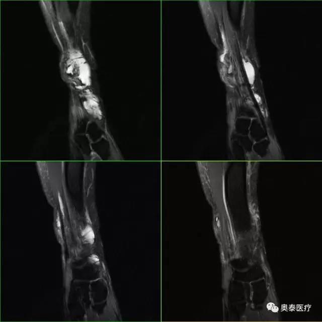【病例】腱鞘囊肿1例MR影像表现 【病例】腱鞘囊肿1例MR影像表现