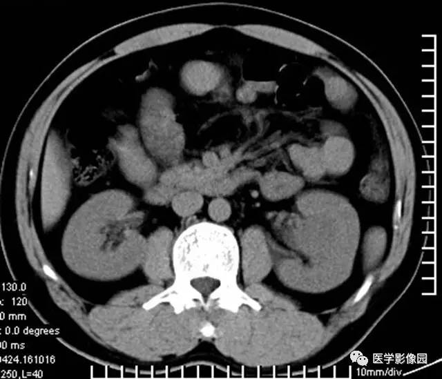【病例】透明细胞癌肾窦内生长1例CT 【病例】透明细胞癌肾窦内生长1例CT