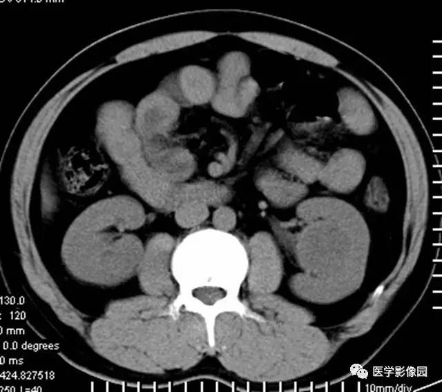 【病例】透明细胞癌肾窦内生长1例CT