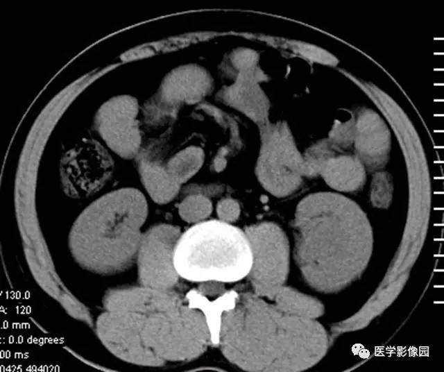 【病例】透明细胞癌肾窦内生长1例CT 【病例】透明细胞癌肾窦内生长1例CT