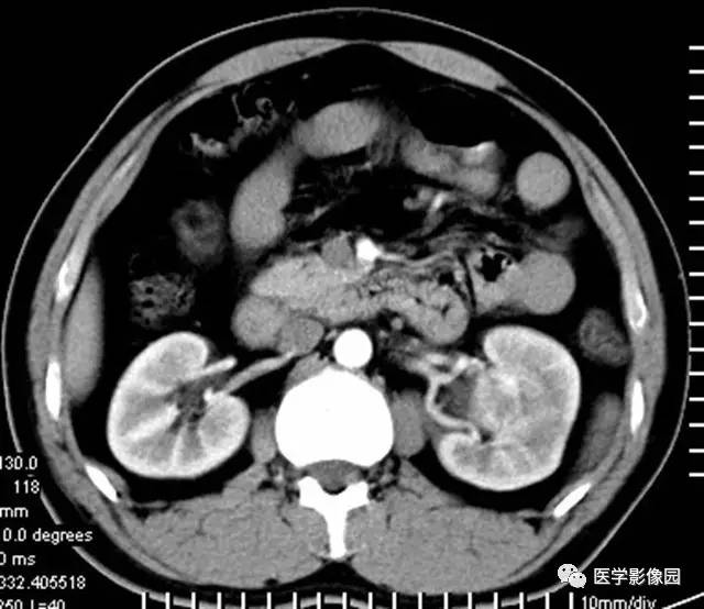 【病例】透明细胞癌肾窦内生长1例CT 【病例】透明细胞癌肾窦内生长1例CT