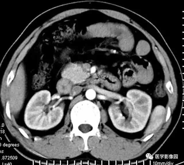 【病例】透明细胞癌肾窦内生长1例CT 【病例】透明细胞癌肾窦内生长1例CT