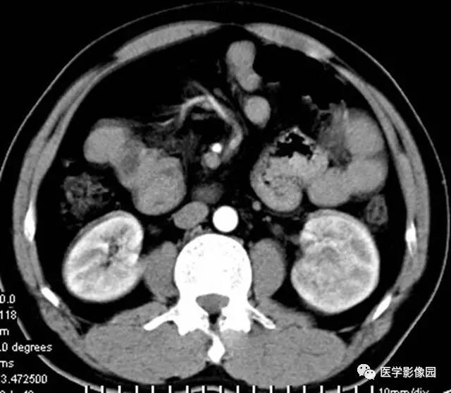 【病例】透明细胞癌肾窦内生长1例CT 【病例】透明细胞癌肾窦内生长1例CT