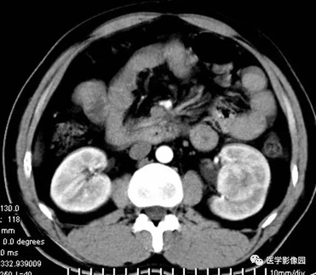 【病例】透明细胞癌肾窦内生长1例CT 【病例】透明细胞癌肾窦内生长1例CT