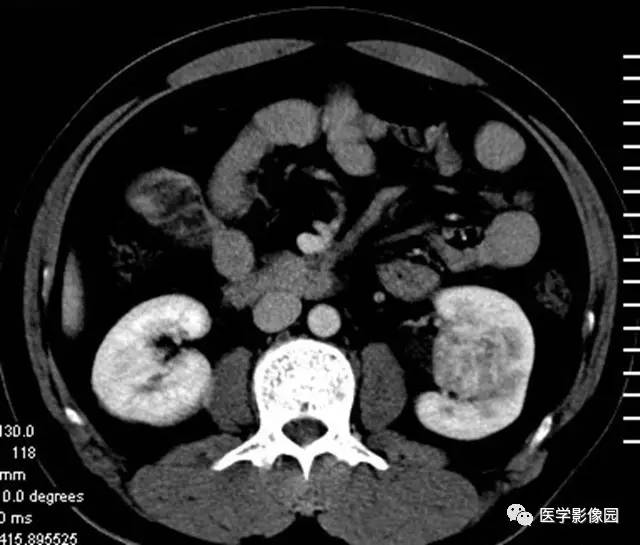 【病例】透明细胞癌肾窦内生长1例CT 【病例】透明细胞癌肾窦内生长1例CT