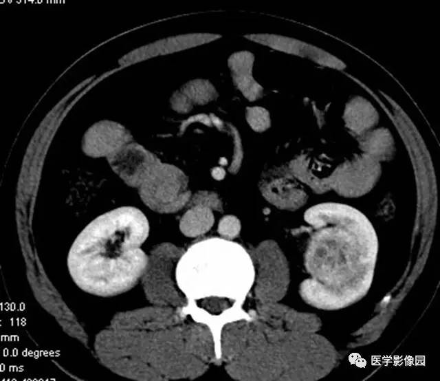 【病例】透明细胞癌肾窦内生长1例CT 【病例】透明细胞癌肾窦内生长1例CT