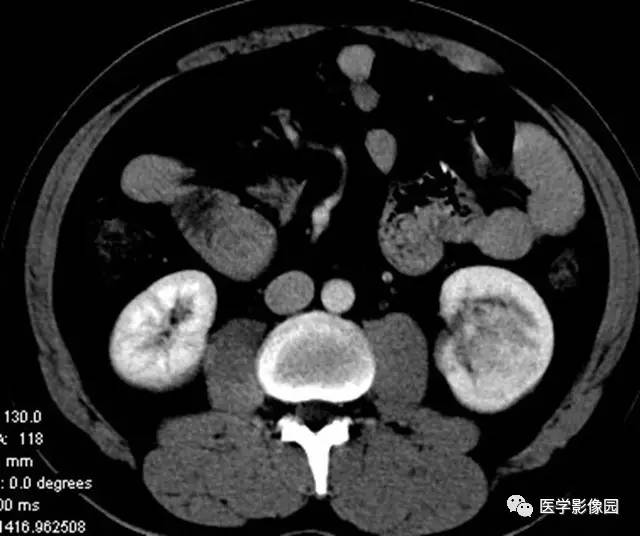 【病例】透明细胞癌肾窦内生长1例CT 【病例】透明细胞癌肾窦内生长1例CT