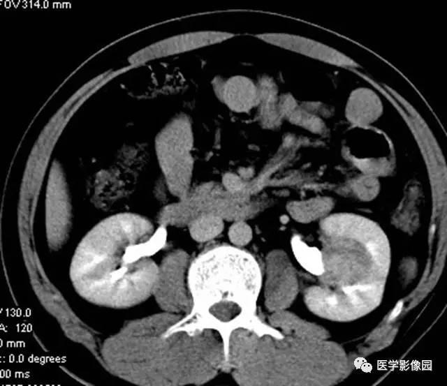 【病例】透明细胞癌肾窦内生长1例CT 【病例】透明细胞癌肾窦内生长1例CT