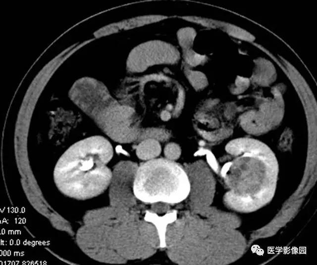【病例】透明细胞癌肾窦内生长1例CT 【病例】透明细胞癌肾窦内生长1例CT