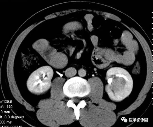 【病例】透明细胞癌肾窦内生长1例CT 【病例】透明细胞癌肾窦内生长1例CT