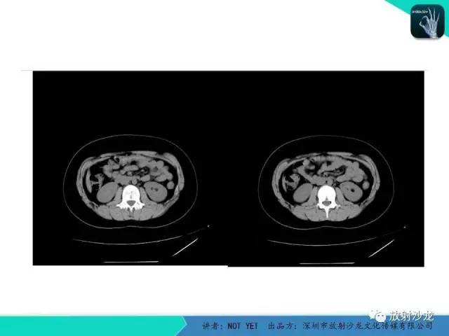 【病例】肾脏血管平滑肌脂肪瘤1例CT影像表现