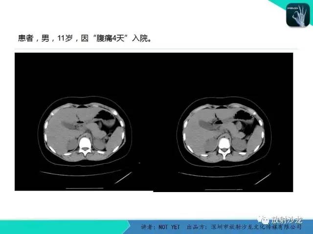 【病例】肾脏血管平滑肌脂肪瘤1例CT影像表现