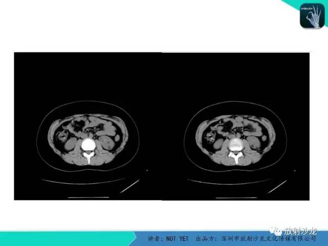 【病例】肾脏血管平滑肌脂肪瘤1例CT影像表现