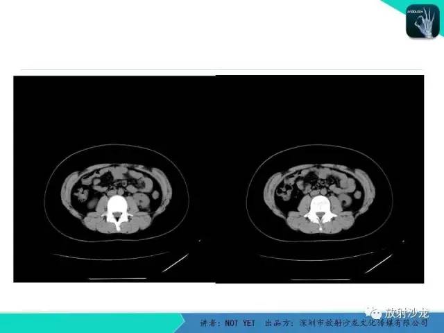 【病例】肾脏血管平滑肌脂肪瘤1例CT影像表现