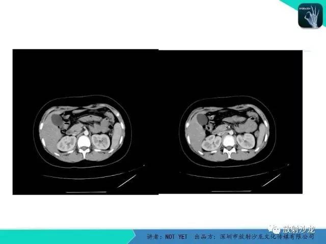 【病例】肾脏血管平滑肌脂肪瘤1例CT影像表现