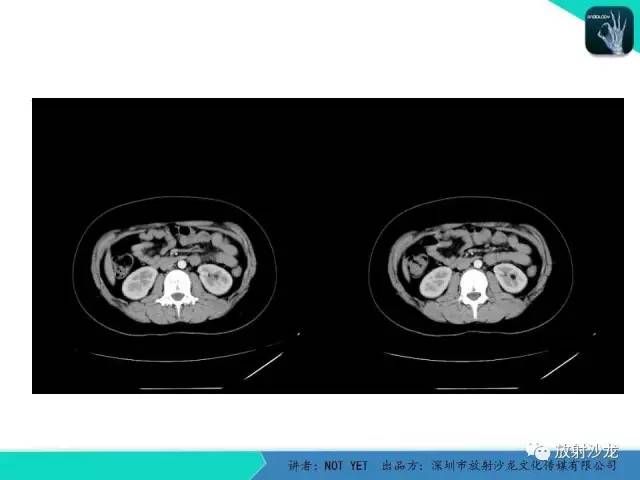 【病例】肾脏血管平滑肌脂肪瘤1例CT影像表现