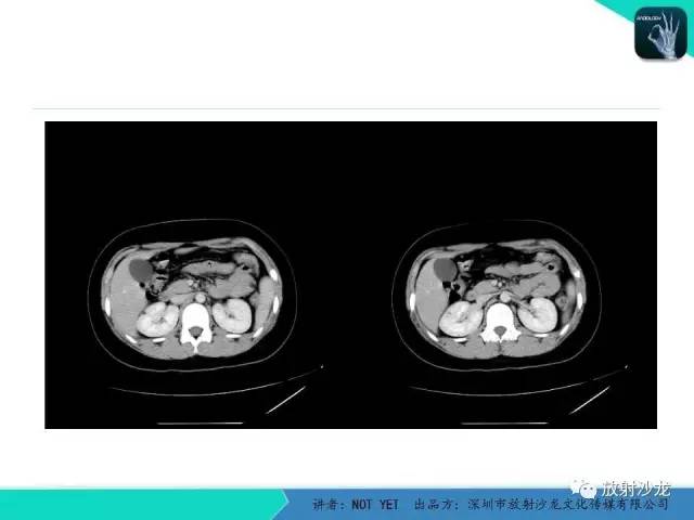 【病例】肾脏血管平滑肌脂肪瘤1例CT影像表现