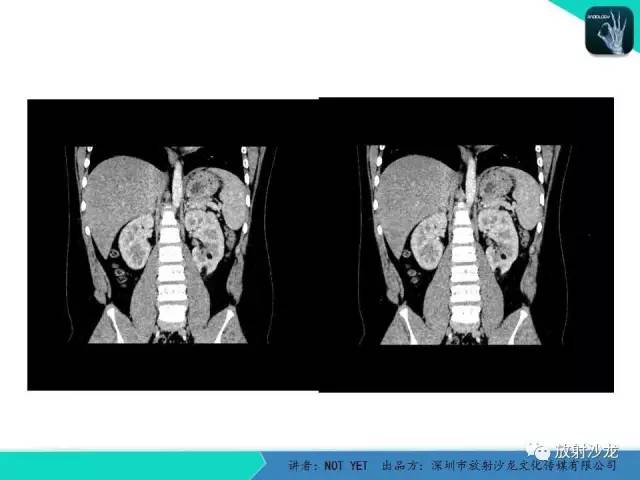 【病例】肾脏血管平滑肌脂肪瘤1例CT影像表现